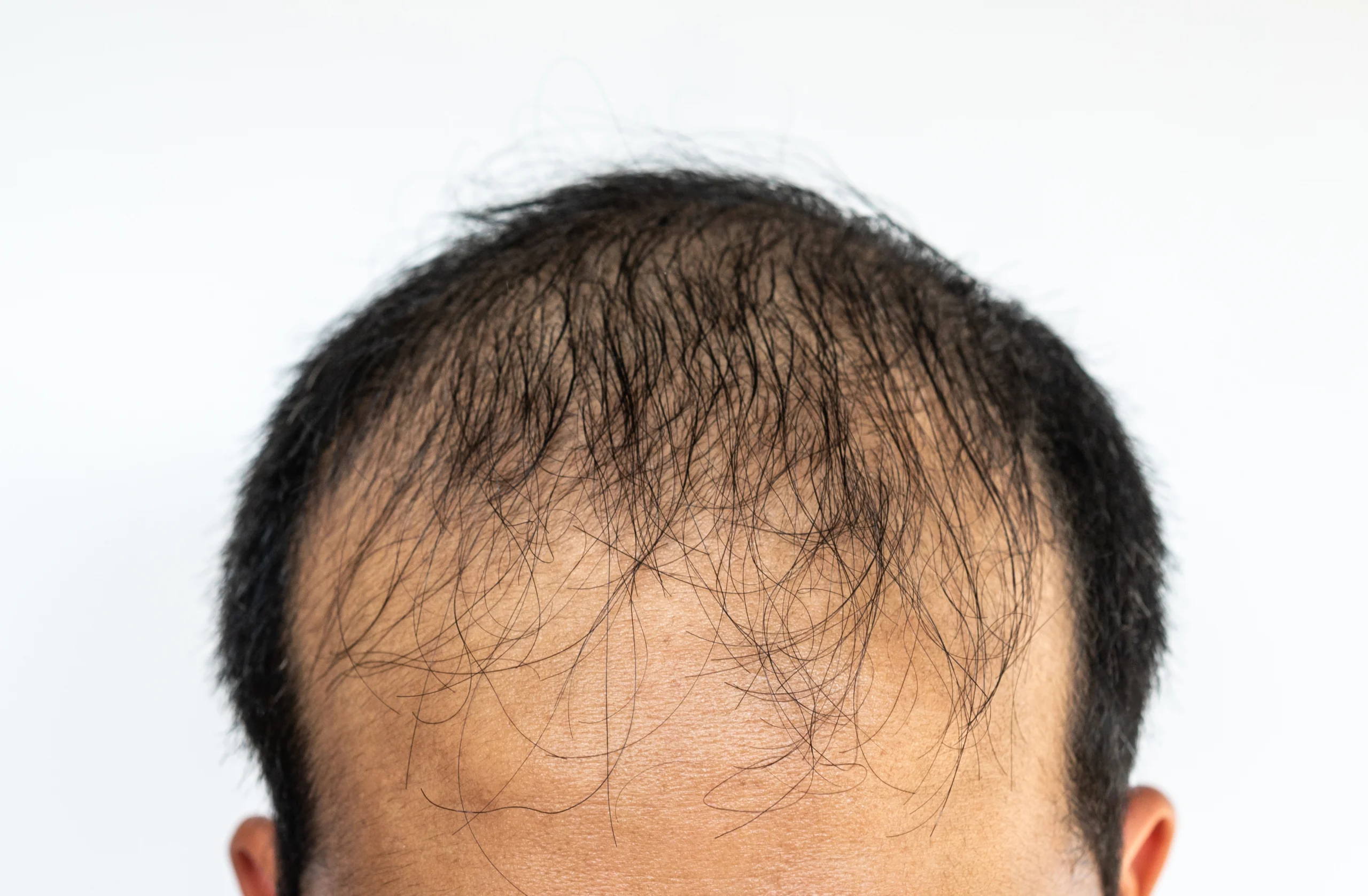 Hair loss in a man